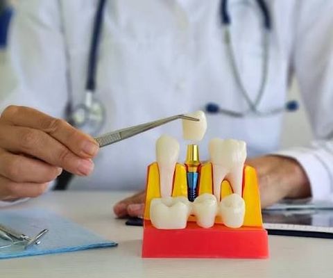 Understanding Dental Implant Equipment: Explanation, Overview, Information, Facts, Expert Insights, and Helpful Resources